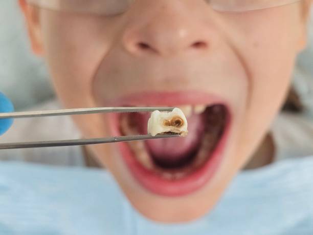 Best Emergency Dentist for Lost Fillings or Crowns in Millbury, OH